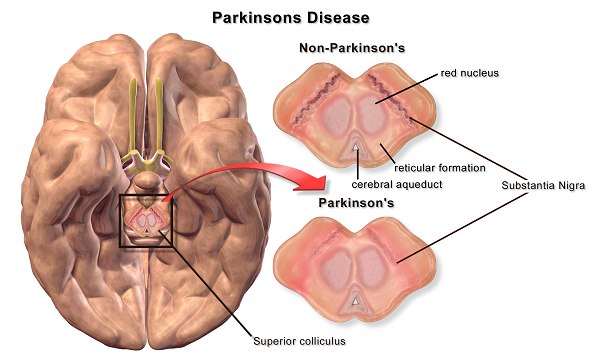 مرض الباركنسون