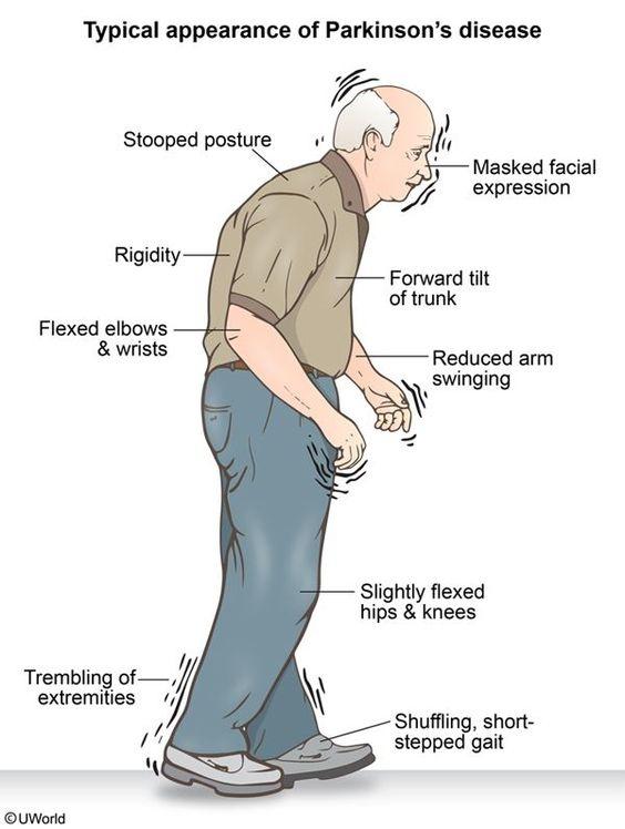 اعراض الشلل الرعاش