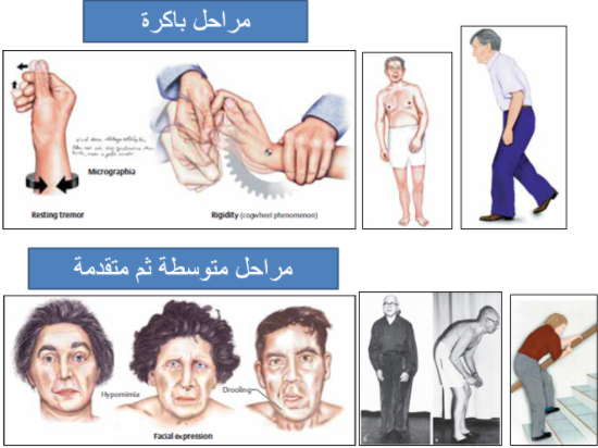 مراحل الباركنسون