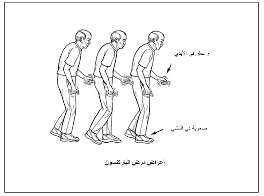 أعراض مرض باركنسون المتقدمة