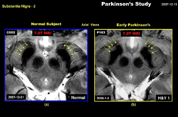 مكان المادة السوداء في الدماغ